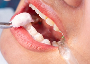 Closeup of someone’s teeth having topical fluoride applied