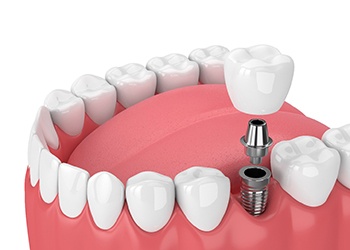 single dental implant with a crown