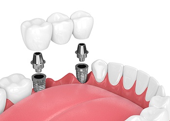 two dental implants holding a bridge