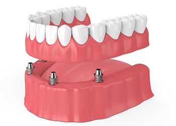 four dental implants holding a full denture 