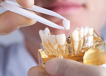 dentist placing a crown on top of a model of a dental implant in the jaw 