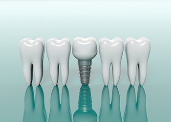 model of a dental implant in the middle of a row of real teeth 
