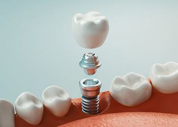 dental implant with abutment and crown being placed in a patient’s jaw 