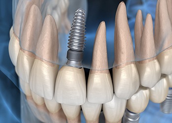 model of a single dental implant in a patient’s upper jaw