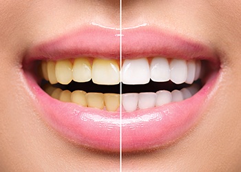 Closeup of smile before and after teeth whitening