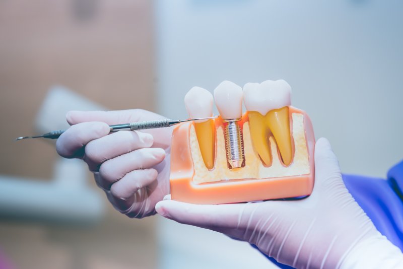 An enlarged model of dental implants in Midland