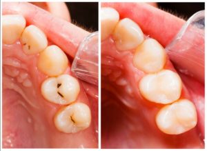 before-and-after showing a tooth-color filling after it has been placed