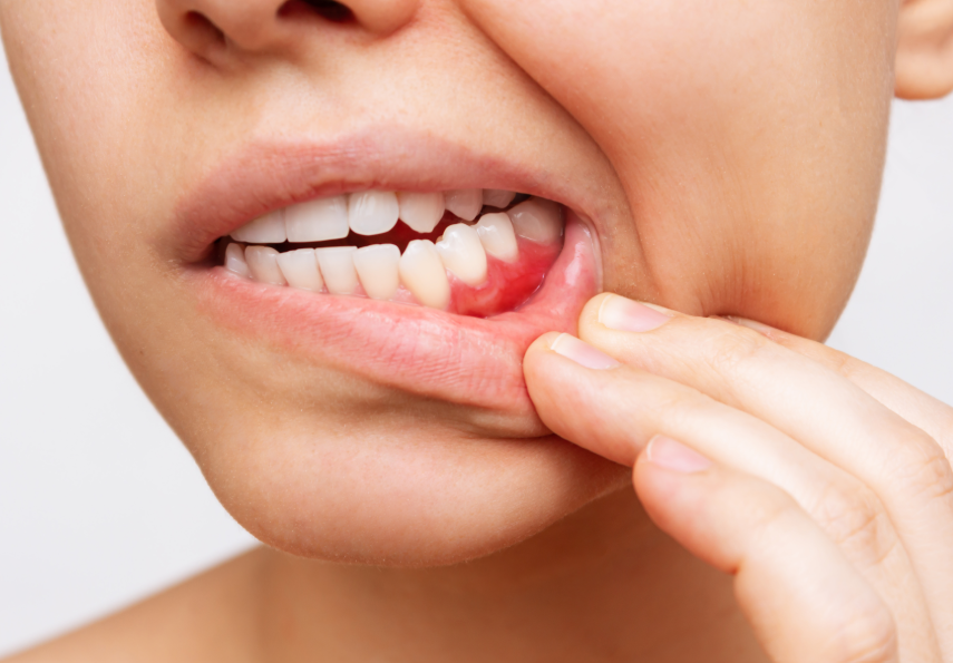 Close up of inflamed gums